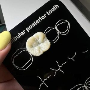 تمپلیت دندان های خلفی